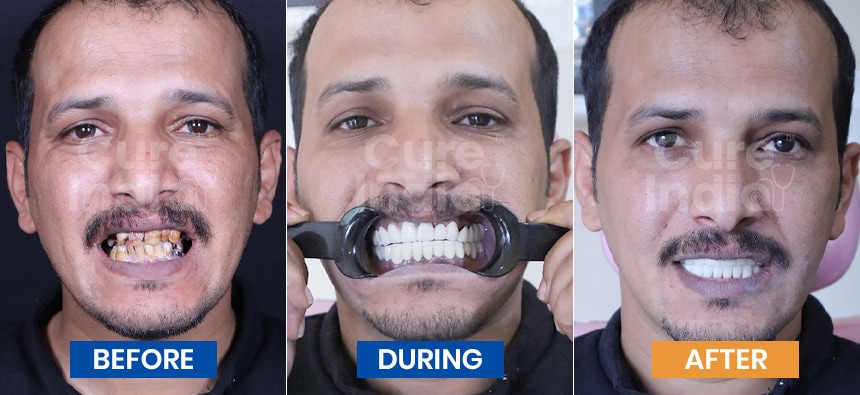 Dental Crown Before and After Case 1
